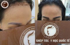 Chi phí cấy lông mày là bao nhiêu?