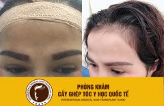 Khắc phục lông mày rụng, thưa không đều màu bằng công nghệ 4.0