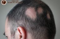 Vùng da đầu bị sẹo có mọc tóc không?
