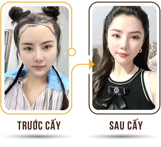 Cấy tóc việt nam