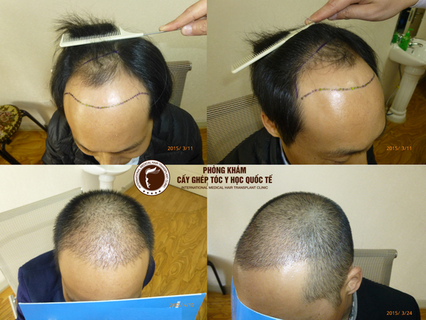 Cấy tóc nam   HÓI CÓ THỂ CHỮA TRỊ ĐƯỢC KHÔNG  Ngày trước bệnh hói  đầu được coi như bệnh nan y bởi vì khó có thể điều trị được
