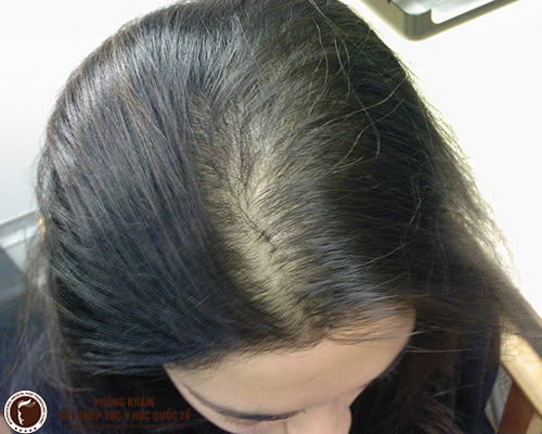 Tóc mỏng - nên làm gì để cải thiện? Phòng khám Cấy ghép tóc Y học Quốc tế