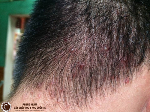 Các vấn đề da đầu thường gặp mà bạn không thể bỏ qua