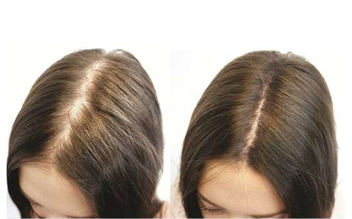 Mách bạn một số mẹo trị rụng tóc nhiều hiệu quả