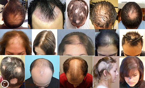 Rụng tóc nhiều ở nam có sao không Cách khắc phục thế nào  Nhà thuốc FPT  Long Châu