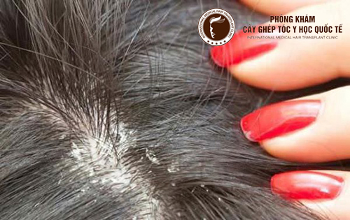 Tóc rụng và nhiều gàu phải làm sao Giải pháp hiệu quả cho người tóc rụng
