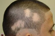 Rụng tóc mảng: Nguyên nhân và cách điều trị