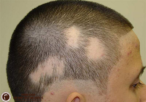 Rụng tóc ở nam giới: Nguyên nhân và các mẹo kích thích mọc tóc