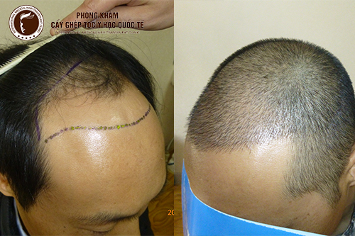 Chương trình cấy tóc khuyến mãi hiện có tại Phòng khám cấy ghép tóc y học quốc tế