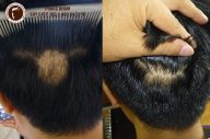 Làm thế nào để tóc mọc trên vùng da đầu bị sẹo?