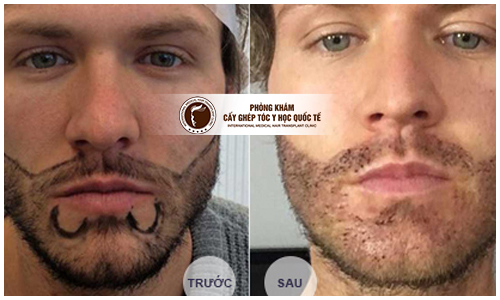 Tìm hiểu về cấy râu thẩm mỹ – nâng tầm vẻ nam tính cho đàn ông
