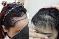 Cấy tóc tự thân – phương pháp trị rụng tóc hiệu quả nhất hiện nay