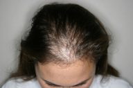 Rụng tóc Androgen – Nguyên nhân và cách khắc phục