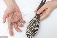 Tất cả những gì cần biết về “Rụng tóc nội tiết tố”