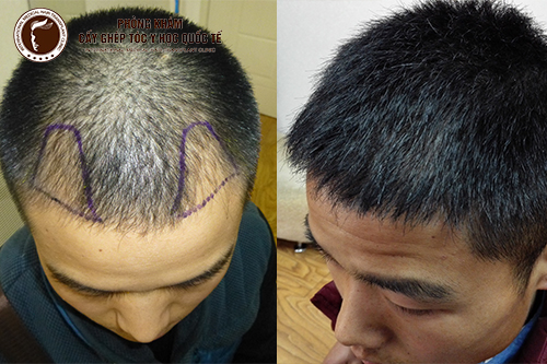Phương pháp điều trị rụng tóc ở xoáy đầu sau một lần thực hiện