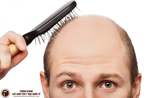 Căn nguyên và biện pháp chữa hói đầu ở nam giới