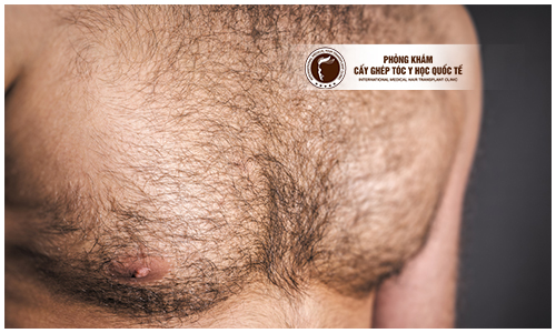 Địa chỉ cấy lông ngực an toàn cho nam giới