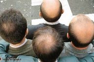 Rụng tóc di truyền có chữa được không ?