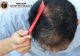 Nguyên nhân gây tóc thưa mỏng và cách khắc phục hiệu quả