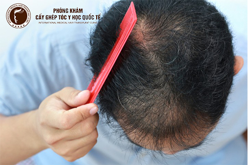 Nguyên nhân gây tóc thưa mỏng và cách khắc phục hiệu quả