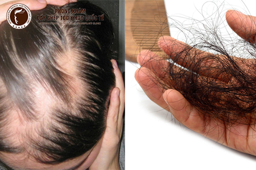 Đừng chủ quan khi rụng tóc nhiều Không khắc phục sớm hậu quả khó lường