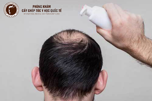 Nguyên nhân và cách điều trị rụng tóc ở nam giới hiệu quả