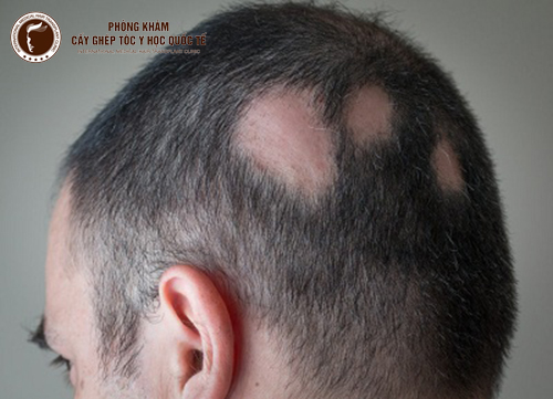 Cấy tóc tự thân – “Phao cứu sinh” trong điều trị rụng tóc từng mảng
