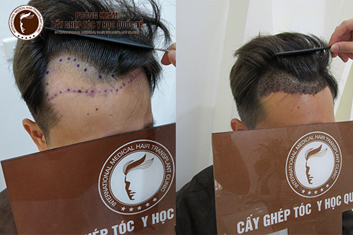 Cấy tóc đường chữ M cho phái mạnh thêm tự tin - Phòng Khám Cấy Ghép Tóc Y  Học Quốc Tế