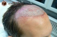 Rủi ro khôn lường vì sử dụng phương pháp cấy tóc không đảm bảo