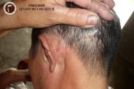Chữa sẹo da đầu bẩm sinh bằng cách nào?