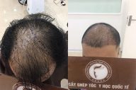 “Bóc mẽ” những sai lầm tai hại trong điều trị tóc thưa đỉnh đầu