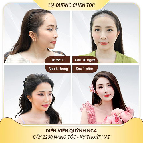 giai đoạn cấy tóc HAT