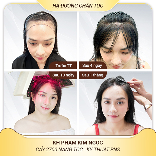 Giới thiệu phương pháp cấy tóc – hiểu đúng để chọn đúng