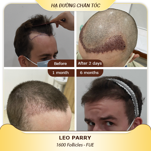 Hair Transplant Healing Process And Result